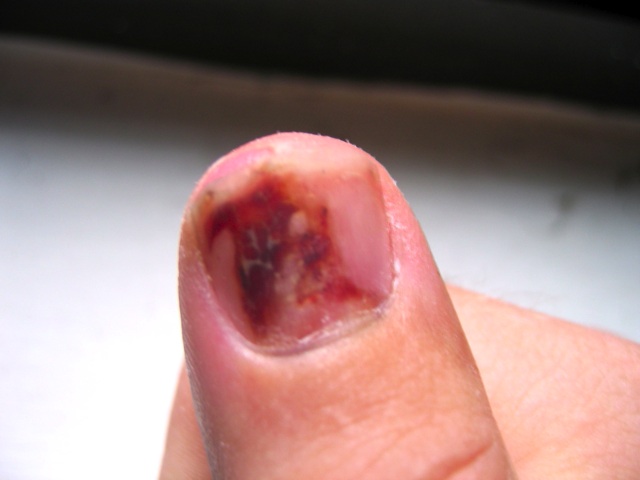 My thumb about two weeks after the noodle.